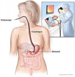 upper-endoscopy